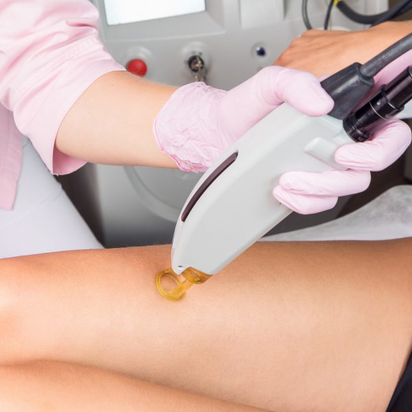 Laser Hair Removal