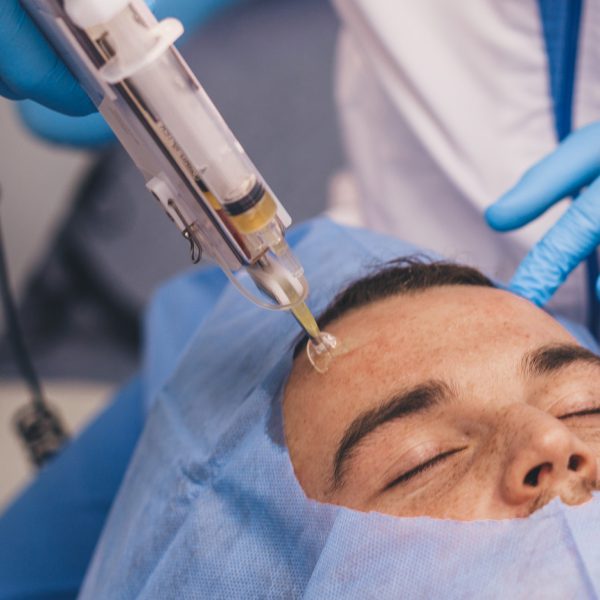 Microneedling